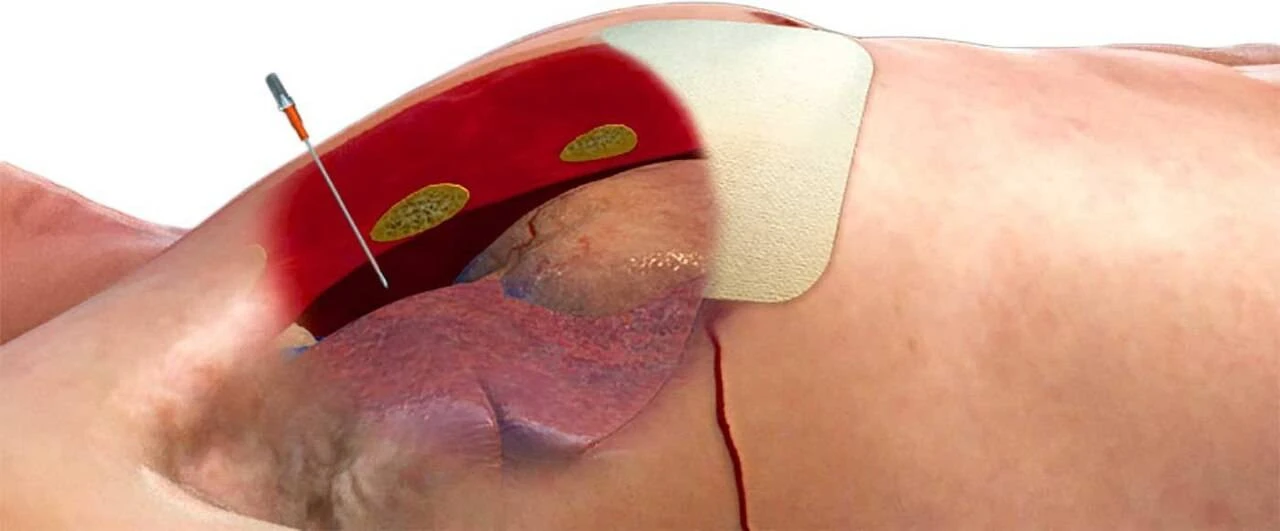 North American Rescue ARS Decompression Needle - NAR-ARS-ZZ-0298 4 North American Rescue ARS Decompression Needle - NAR-ARS-ZZ-0298 - Image 2